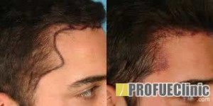 Hajátültetés - hajbeültetés - hajtranszplantáció előtte utána képek 