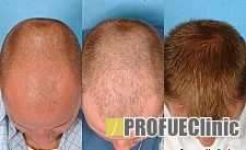 Hajátültetési, hajbeültetési tapasztalatok – beszámolók és eredmények Hajátültetési, hajbeültetési tapasztalatok – beszámolók és eredmények