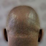 hajtranszplantáció korrekció