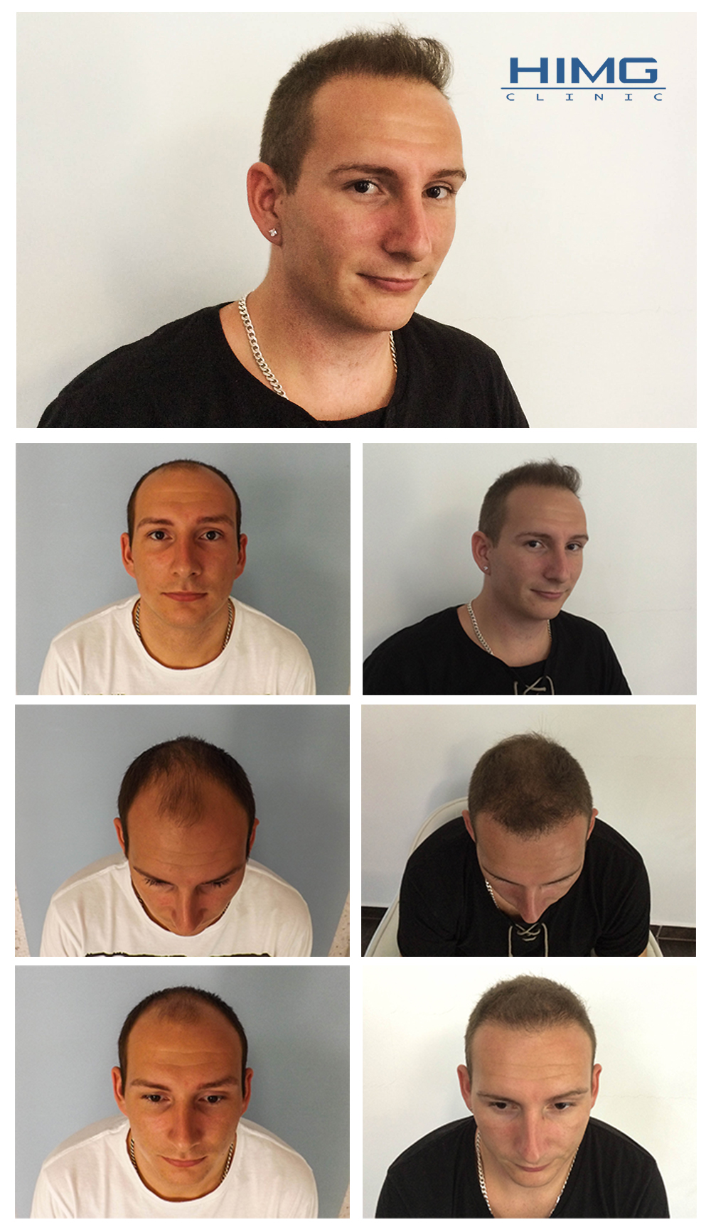 b-adam-hajbeultetes-elott-utan