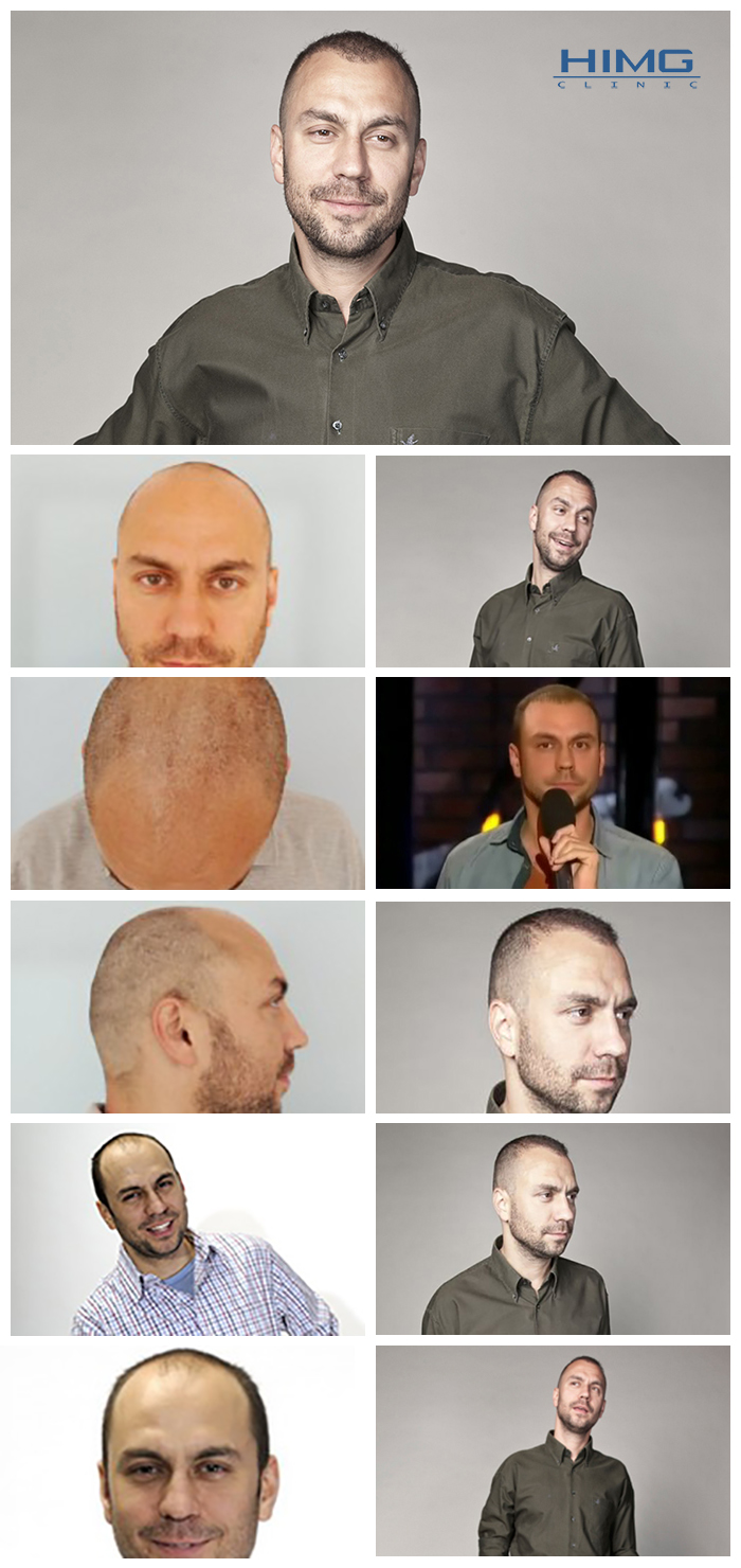 csenki-attila-hajbeultetes-elott-utan