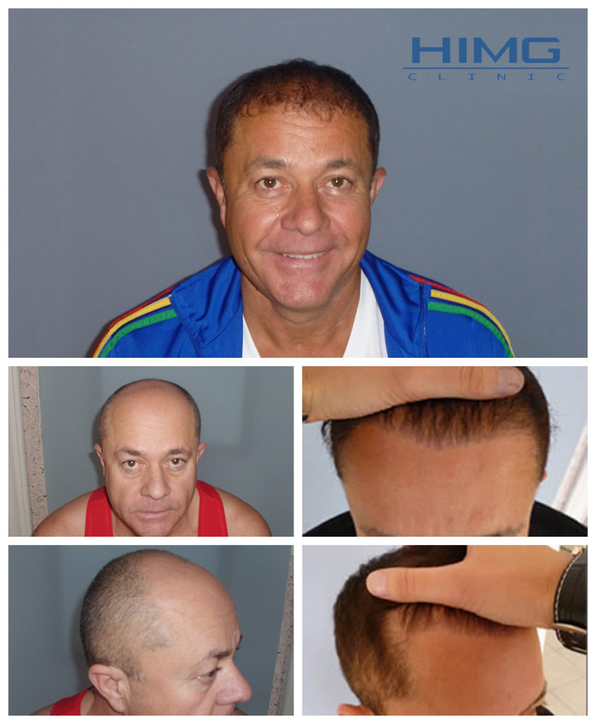 csuka-zoltan-hajbeultetes-elott-utan