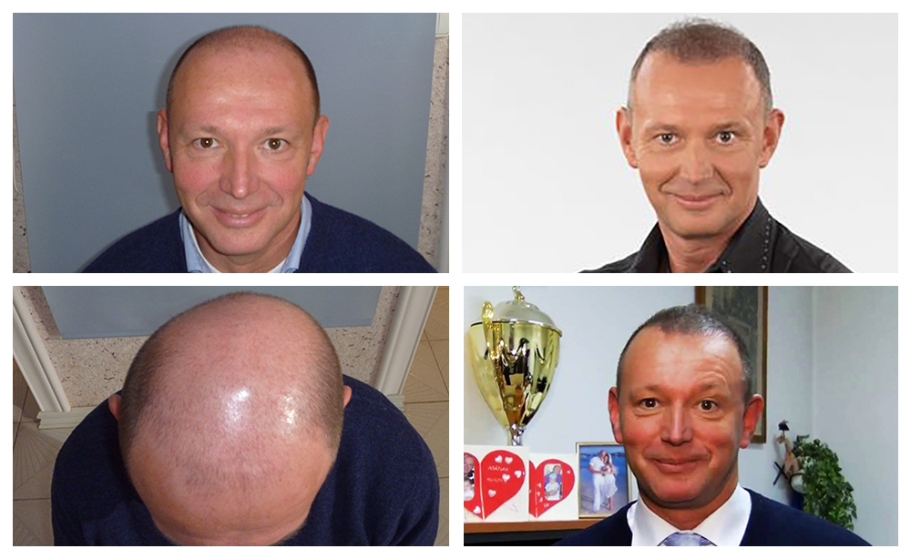 gyorfi-pal-hajbeultetes-elott-utan