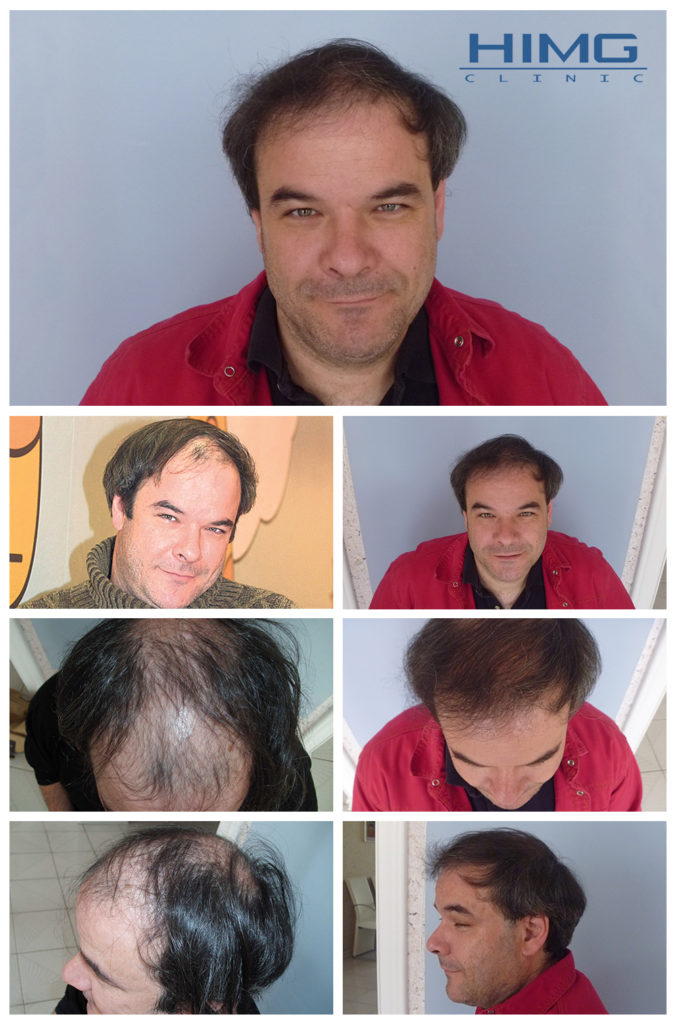 kalloy-molnar-peter-hajbeultetes-elotte-utana-kepek