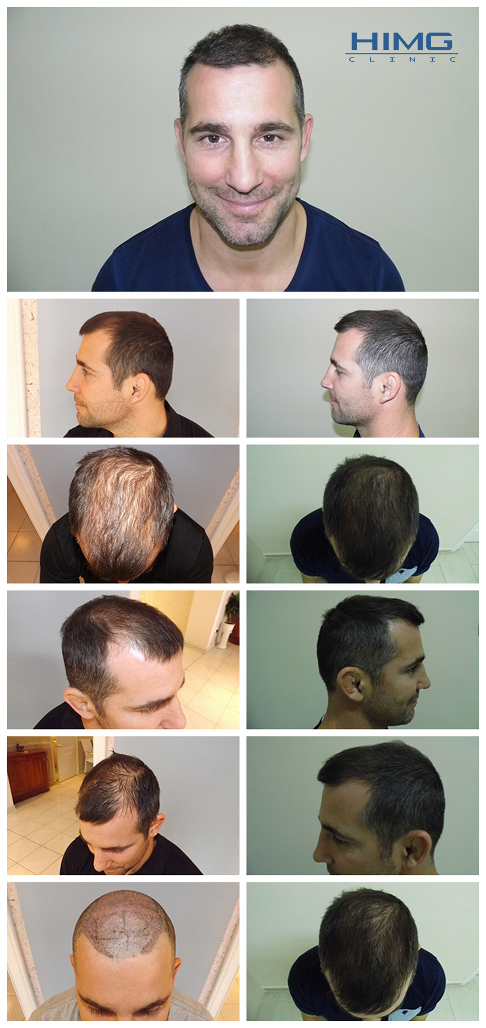 ritter-arpad-hajbeultetes-elott-utan1