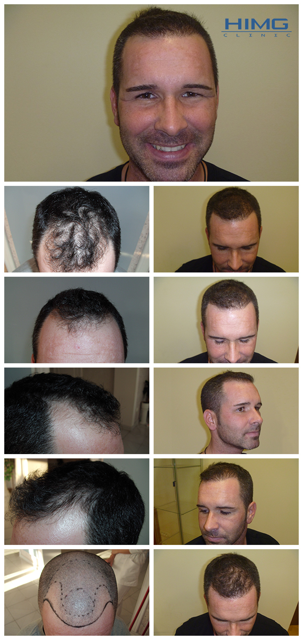 vincze-zsolt-hajbeultetes-elott-utan1