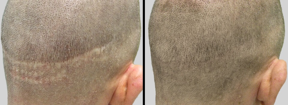 SMP (Fejbőr Mikropigmentáció) előtt és után