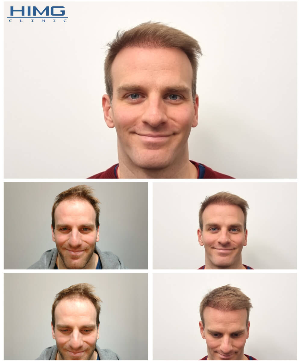 Hajbeültetés előtte-utána: Lénárd - HIMG Hajbeültetési Klinika